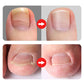 📢📢60 % DE RÉDUCTION !!⏰Coupe-ongles professionnels pour ongles incarnés 7 pièces